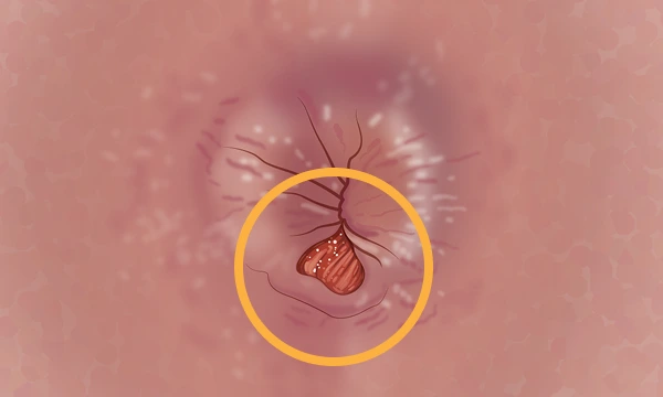 image of acute AF, space permitting